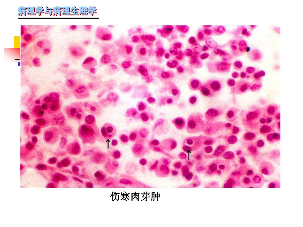 病毒性肝炎 → 变质性炎 流行性脑脊髓膜炎 → 渗出性炎 伤寒→ 增生