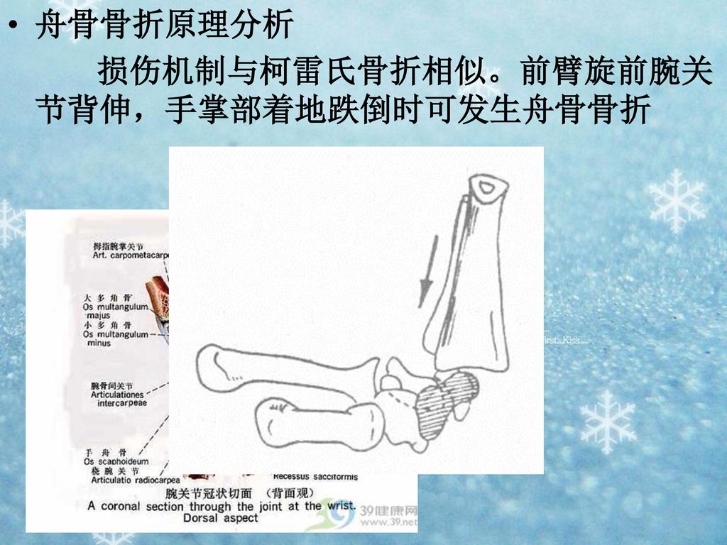 舟骨骨折原理分析 损伤机制与柯雷氏骨折相似。前臂旋前腕关节背伸，手掌部着地跌倒时可发生舟骨骨折