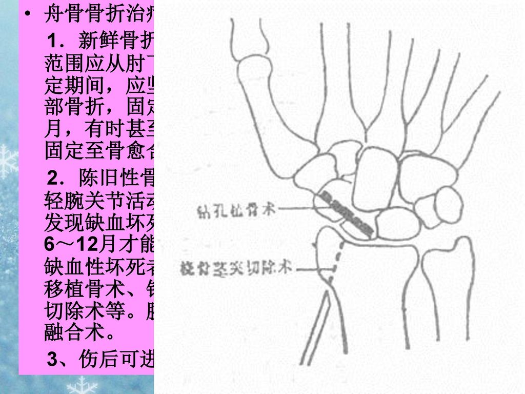 舟骨骨折治疗分析： 1．新鲜骨折：用前臂石膏管型固定于功能位，石膏范围应从肘下到远侧掌横纹，拇指包括近侧指节。固定期间，应坚持手指功能锻炼，以免关节强直。结节部骨折，固定4～6周，腰部或近端骨折固定3～4个月，有时甚至半年或一年。每2～3个月定期照片检查，固定至骨愈合为止。