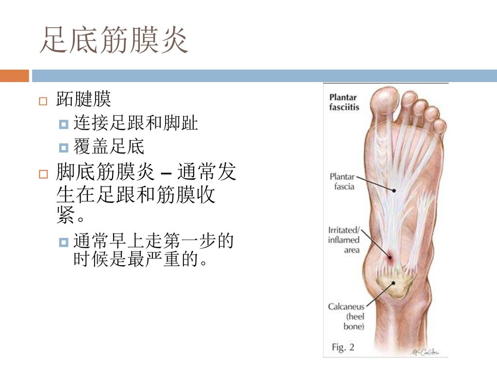 足底筋膜炎 跖腱膜 连接足跟和脚趾 覆盖足底 脚底筋膜炎 – 通常发 生在足跟和筋膜收紧。 通常早上走第一步的 时候是最严重的。
