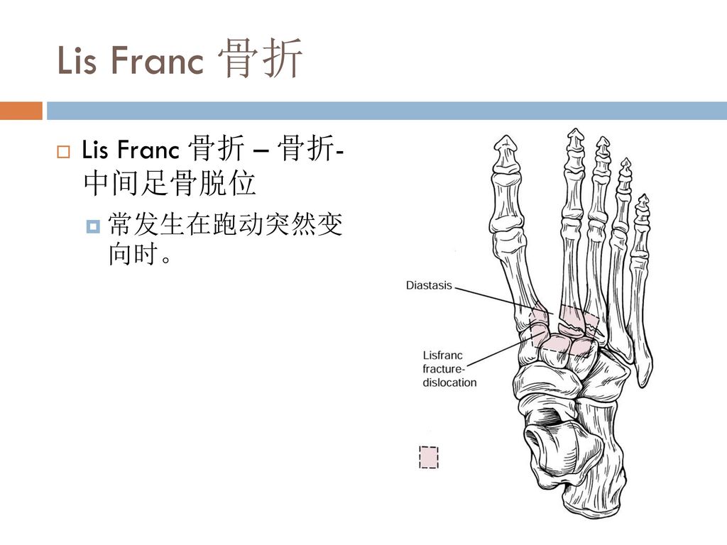 Lis Franc 骨折 Lis Franc 骨折 – 骨折- 中间足骨脱位 常发生在跑动突然变 向时。