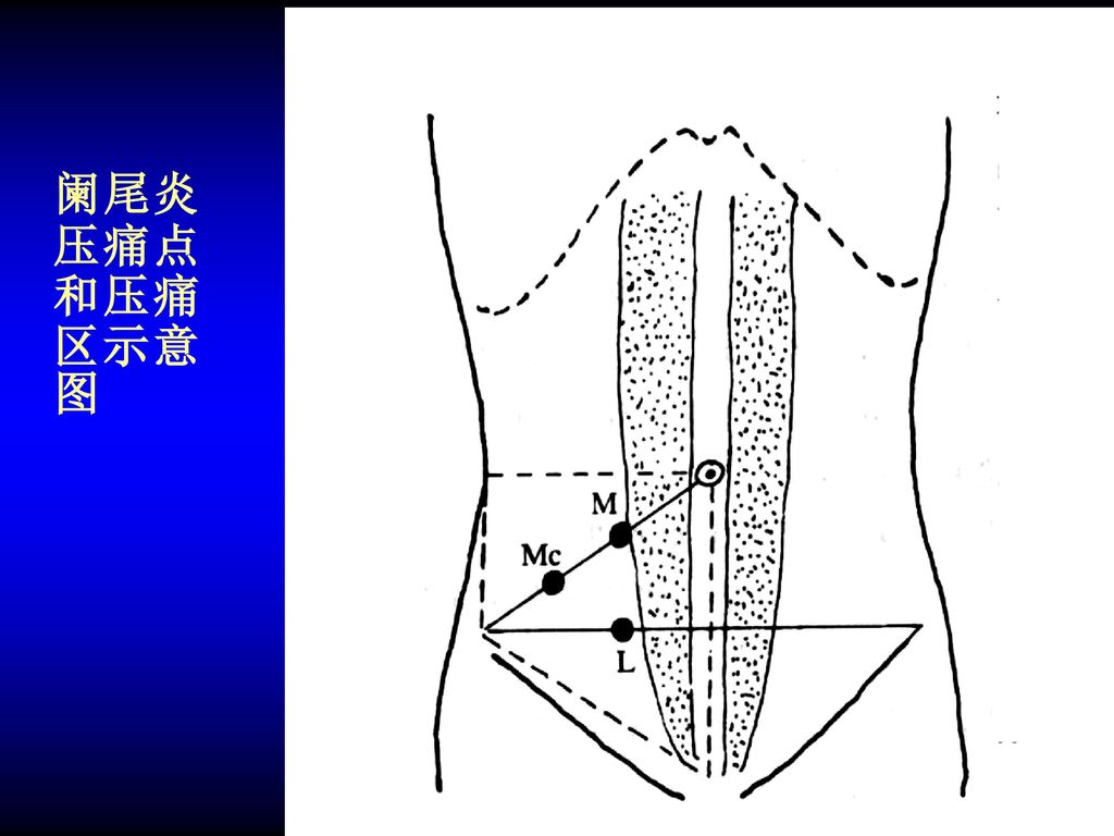 阑尾体表投影 阑尾炎压痛点和压痛区示意图 腰大肌征的示意图rovsing