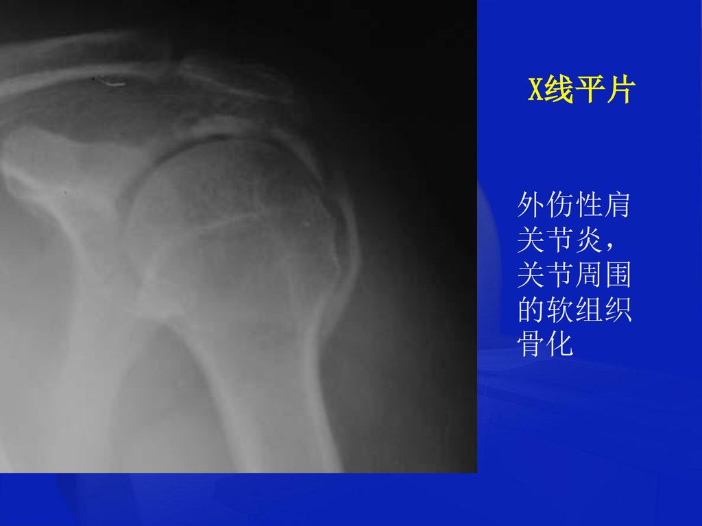 X线平片 外伤性肩关节炎，关节周围的软组织骨化