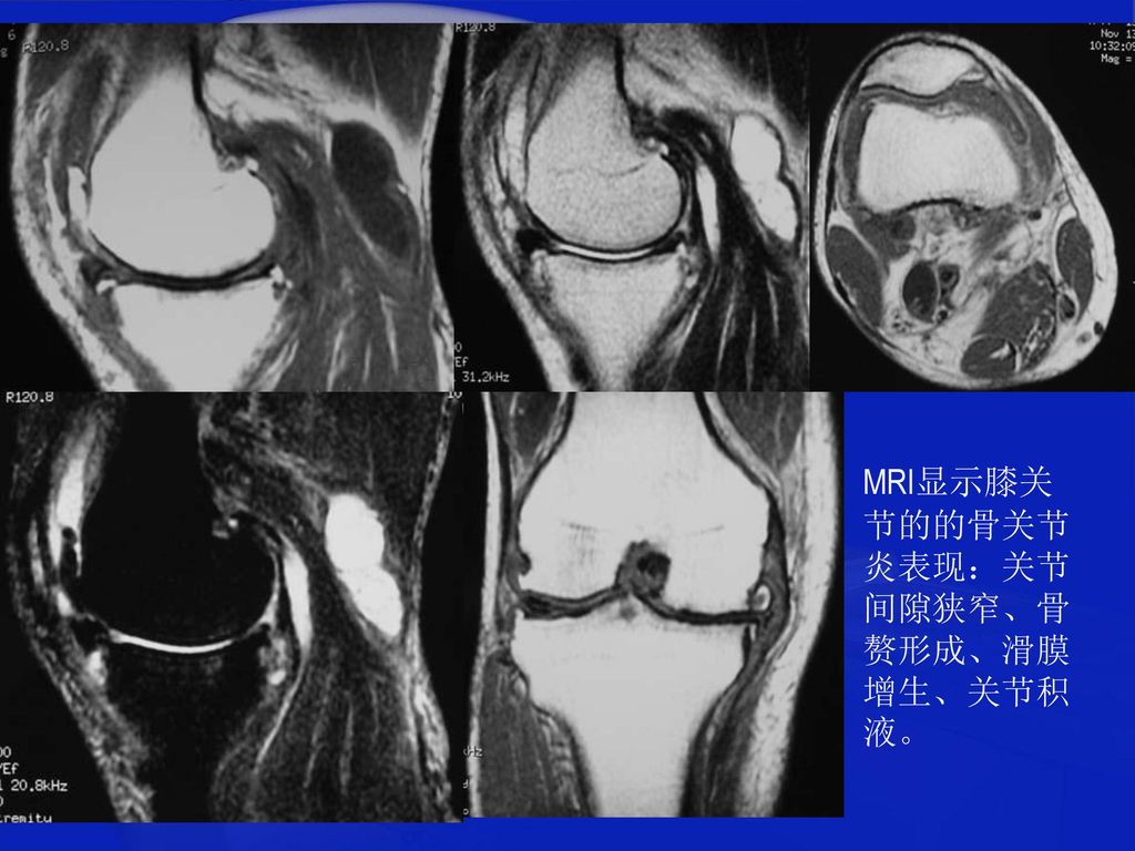 MRI显示膝关节的的骨关节炎表现：关节间隙狭窄、骨赘形成、滑膜增生、关节积液。