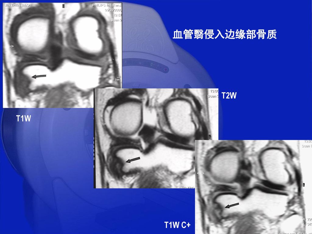 血管翳侵入边缘部骨质 T2W T1W T1W C+