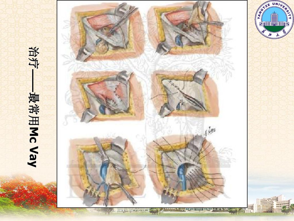 57                股疝-femoral hernia股疝——经股环,股管,卵圆窝