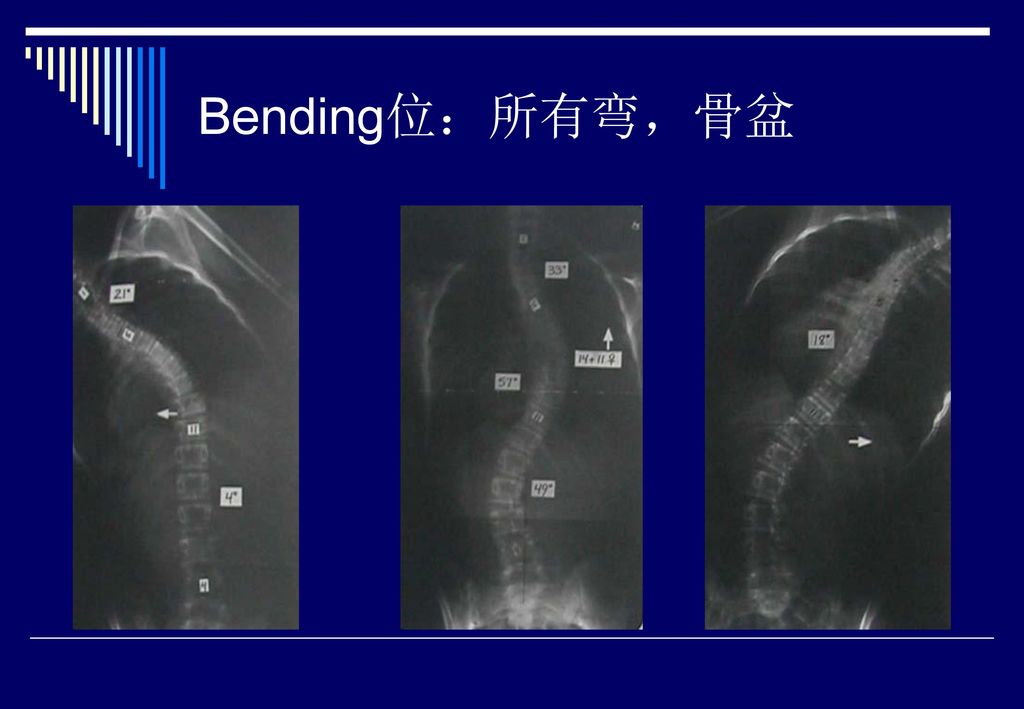 特发性脊柱侧弯 adolescence idiopathic scoliosis