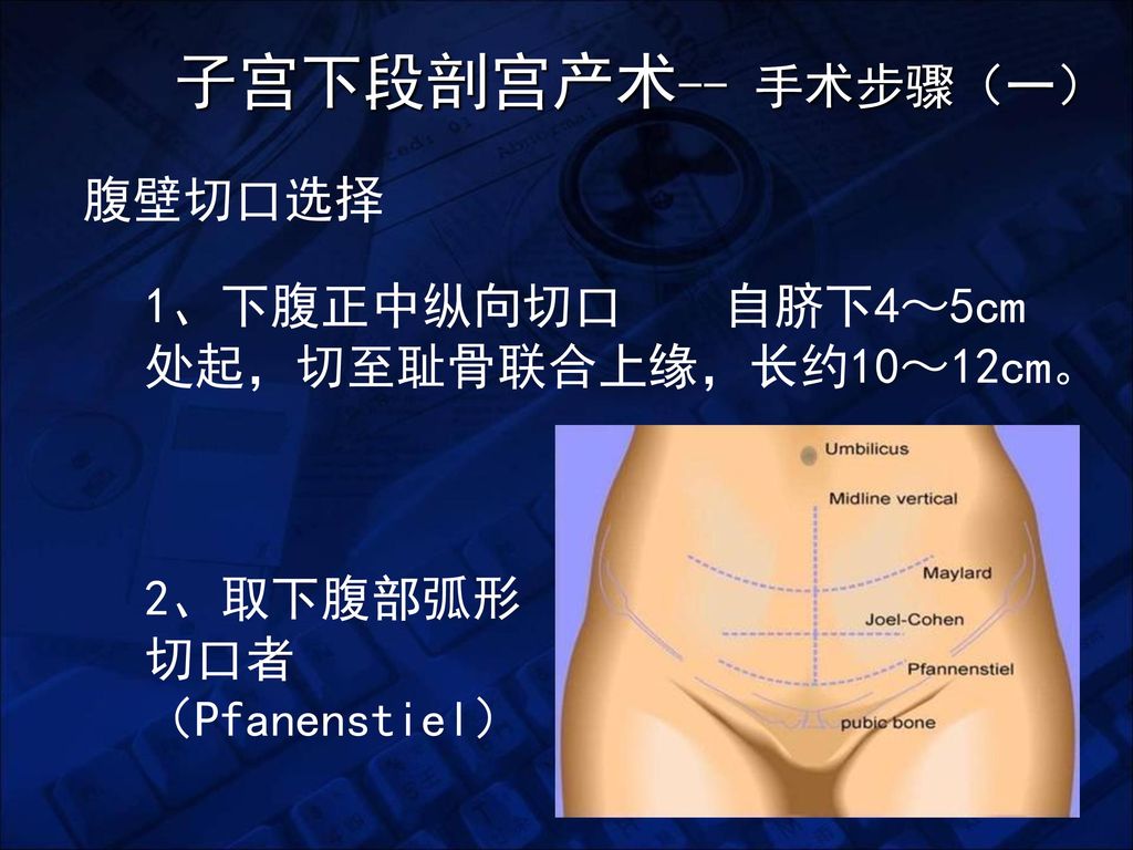 子宫下段剖宫产术-- 手术步骤（一） 腹壁切口选择 1、下腹正中纵向切口 自脐下4～5cm处起，切至耻骨联合上缘，长约10～12cm。