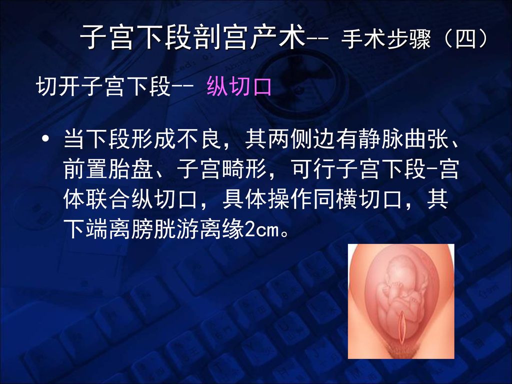 子宫下段剖宫产术-- 手术步骤（四） 切开子宫下段-- 纵切口