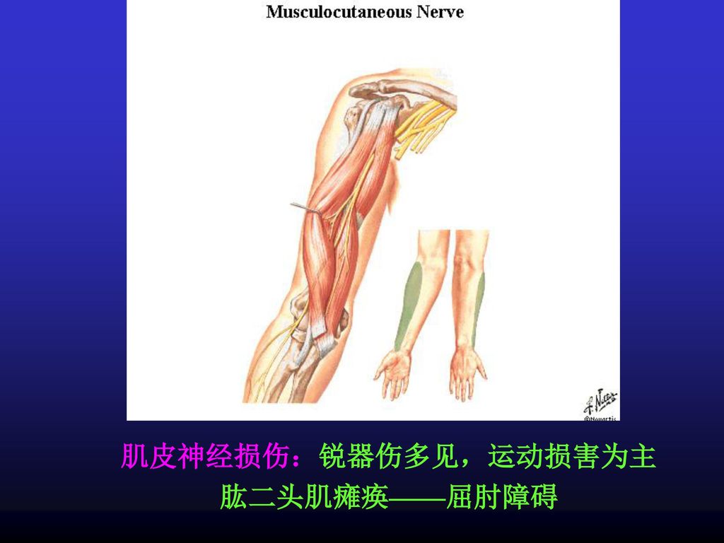 肌皮神经损伤：锐器伤多见，运动损害为主 肱二头肌瘫痪——屈肘障碍