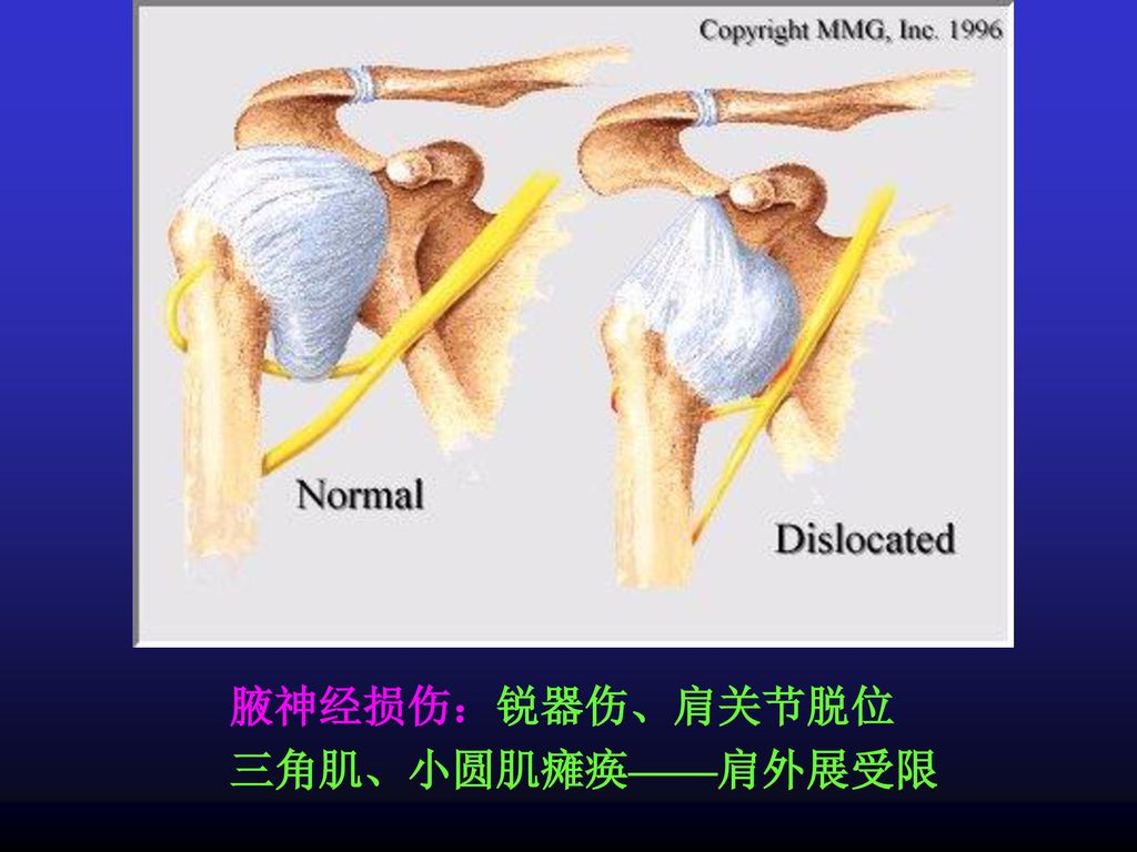 腋神经损伤：锐器伤、肩关节脱位 三角肌、小圆肌瘫痪——肩外展受限
