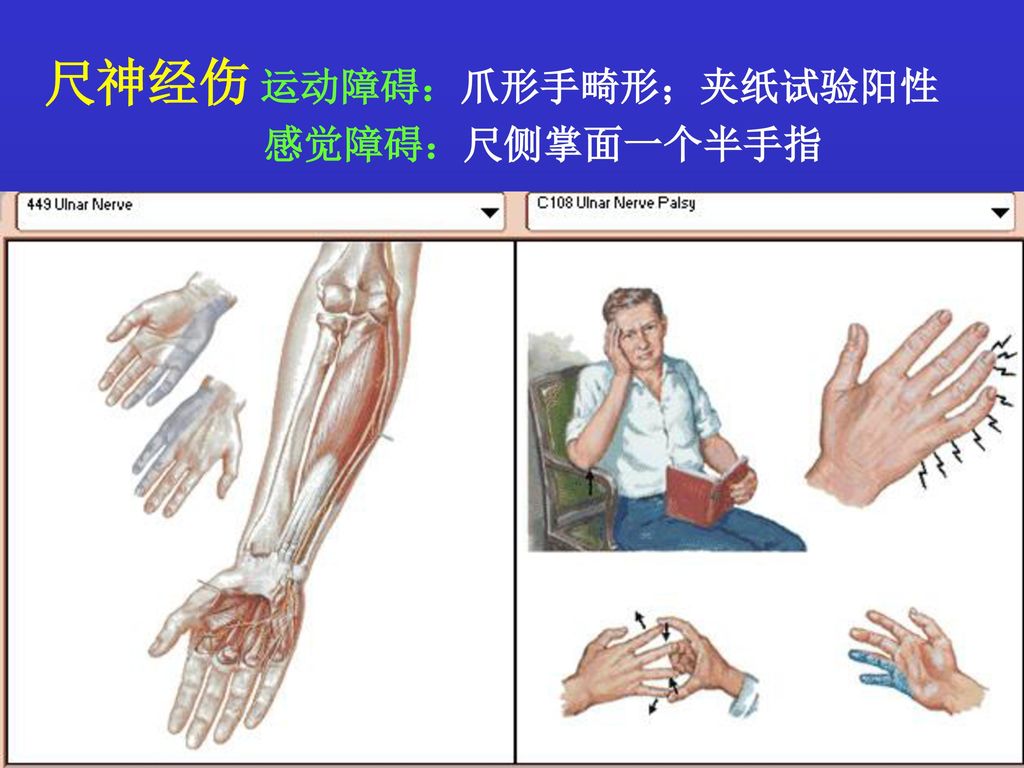 尺神经伤 运动障碍：爪形手畸形；夹纸试验阳性 感觉障碍：尺侧掌面一个半手指