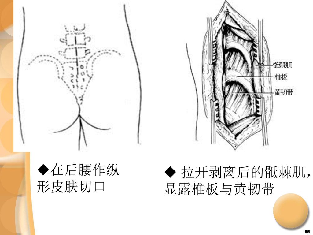 在后腰作纵 形皮肤切口 拉开剥离后的骶棘肌，显露椎板与黄韧带