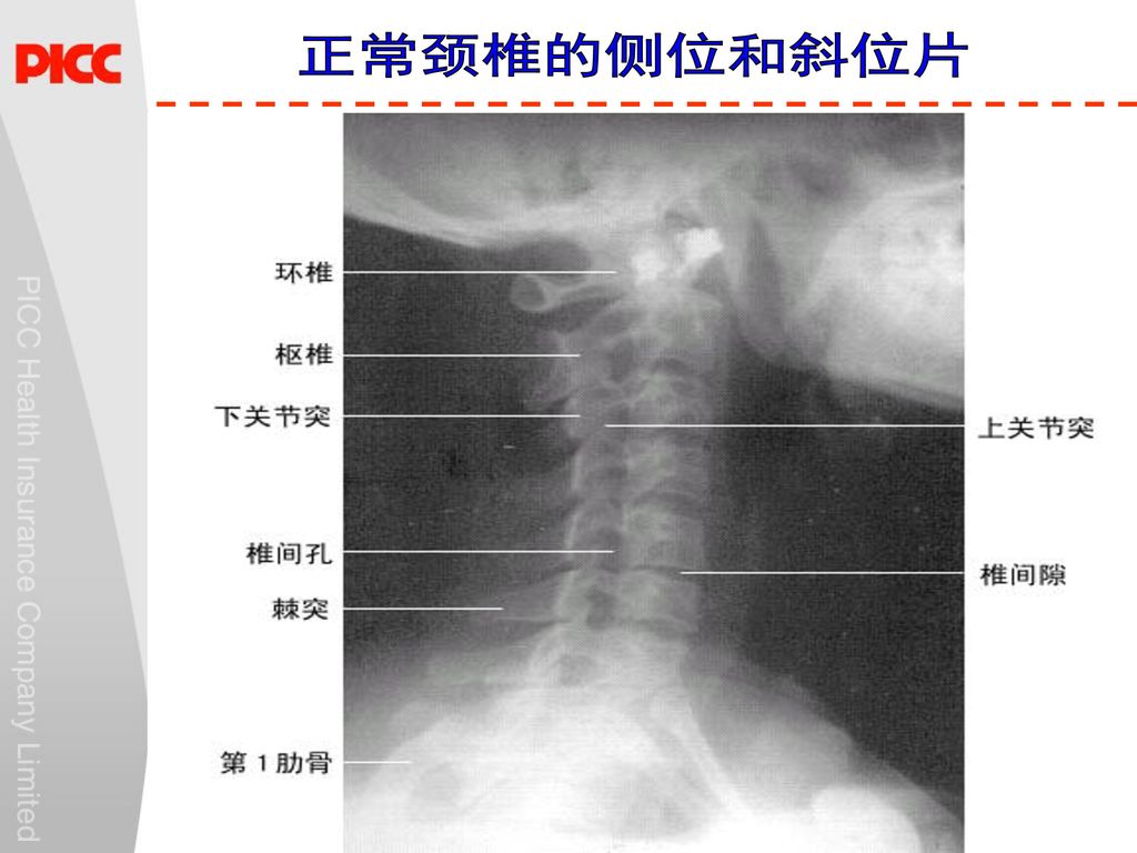 防2009年健管系统二期专业视频培训课程 颈椎病的 治 江苏分公司健康