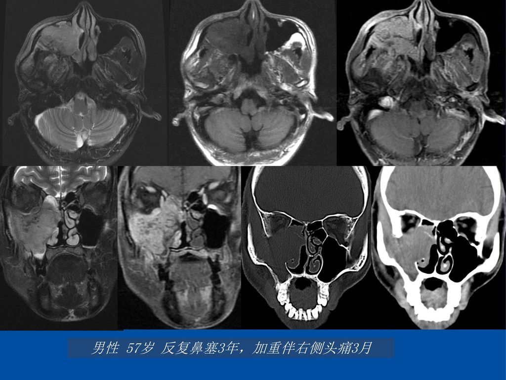 低分化鳞状细胞癌 男性 57岁 反复鼻塞3年，加重伴右侧头痛3月