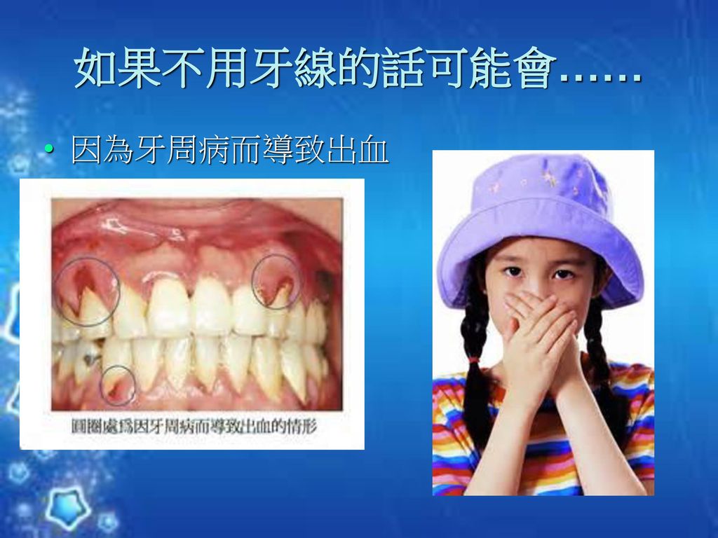如果不用牙線的話可能會…… 因為牙周病而導致出血