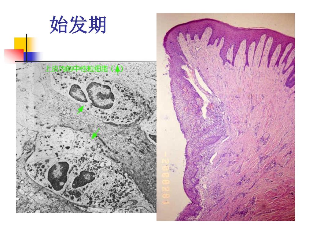 三,牙周炎的发病机制 牙周炎的发病机理:宿主的防御机制在抵御病原微