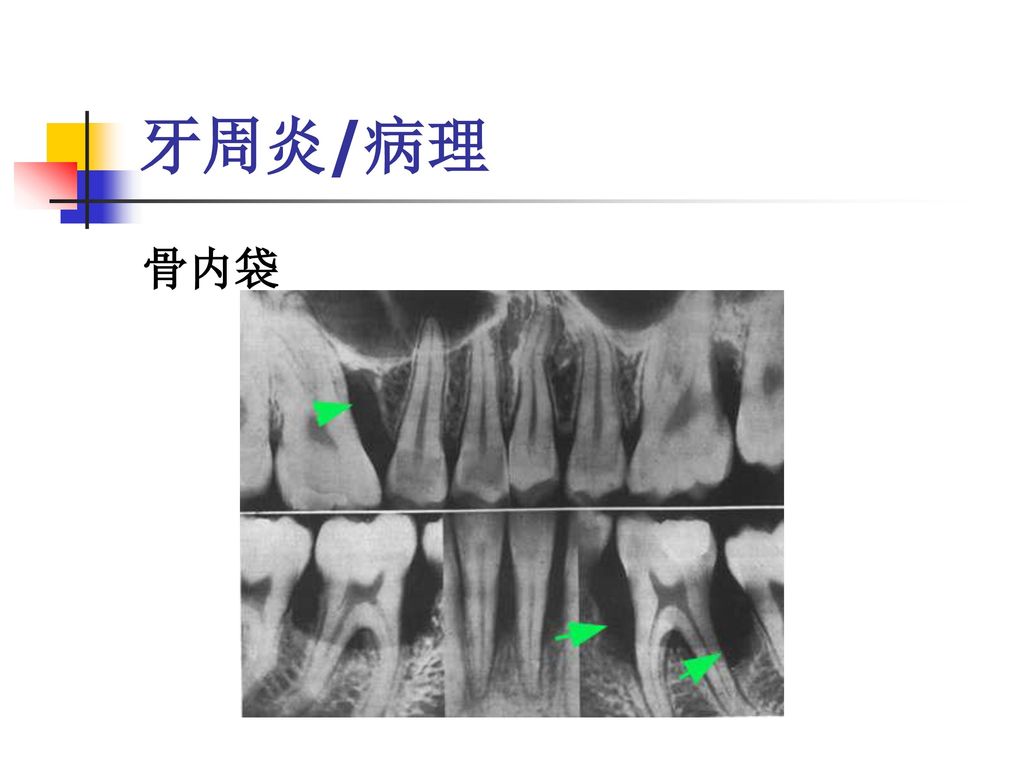 与牙周袋形成在临床病理上可分为三种情况: 龈袋(gingival pocket) 骨