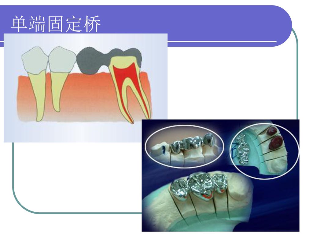 基牙,固位体,桥体,连接体粘固剂固定义齿是利用缺牙区一侧或两侧的