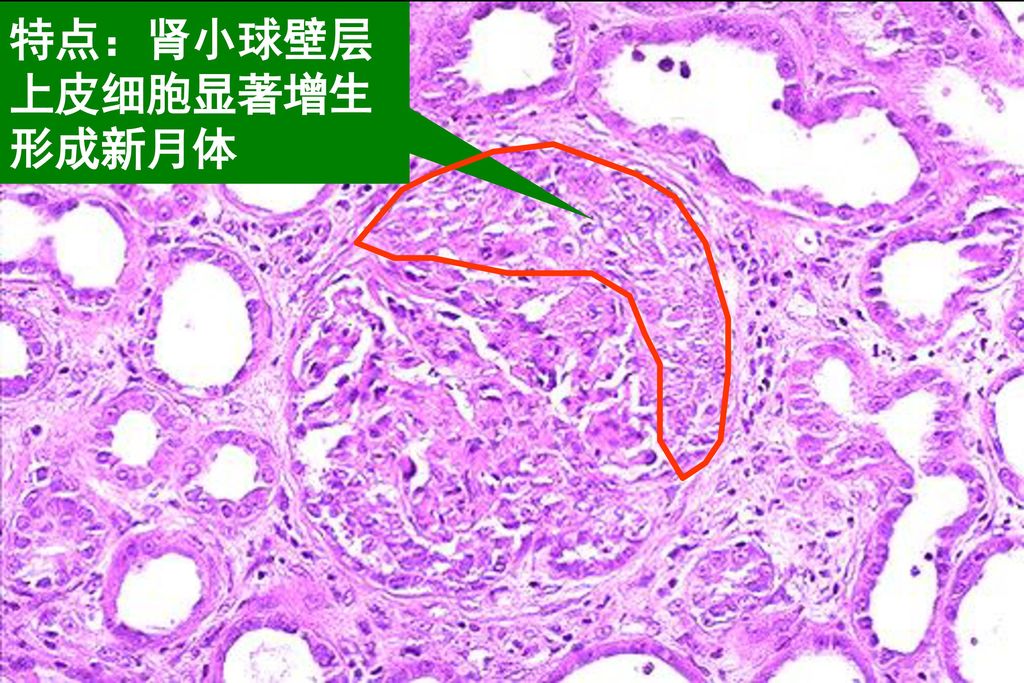 纤维素渗出是刺激新月体形成的要素纤维素沉积于肾小球