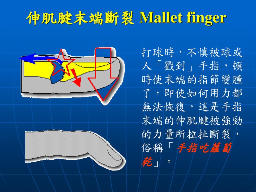 伸肌腱末端斷裂 Mallet finger 打球時，不慎被球或人「戳到」手指，頓時使末端的指節變腫了，即使如何用力都無法恢復，這是手指末端的伸肌腱被強勁的力量所拉扯斷裂，俗稱「手指吃蘿蔔乾」。