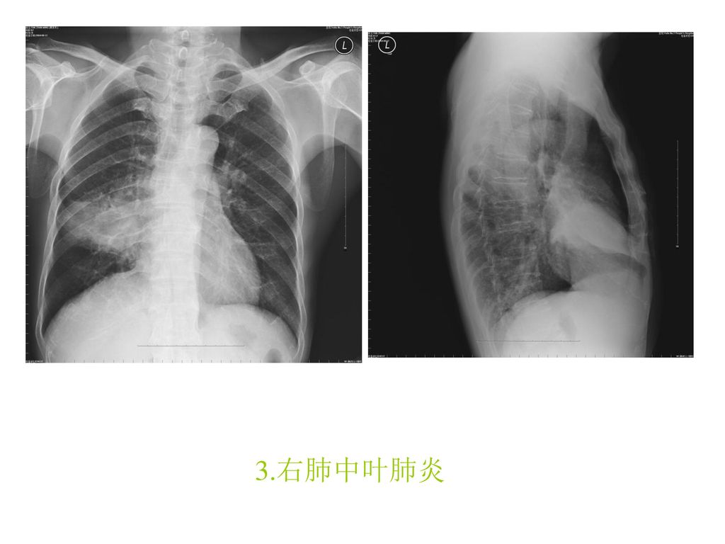 第二部分:心电图.