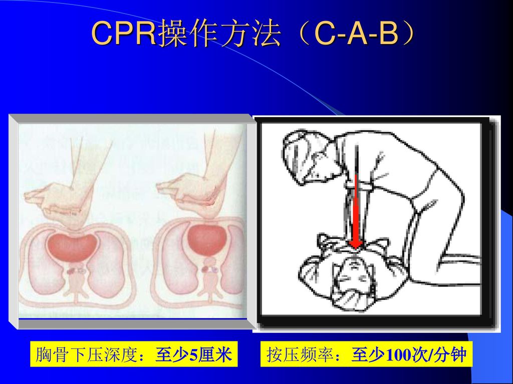 CPR操作方法（C-A-B） 胸骨下压深度：至少5厘米 按压频率：至少100次/分钟