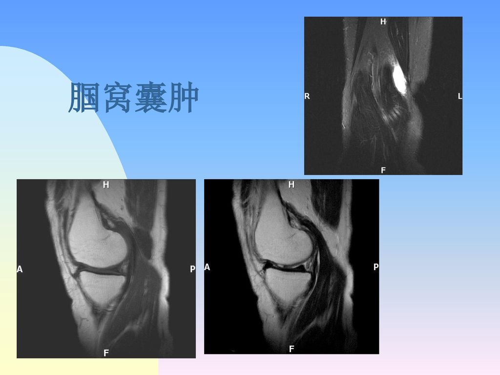 t2wi:地图样高信号 左膝关节骨挫伤 膝关节囊肿半月板囊肿膎窝囊肿