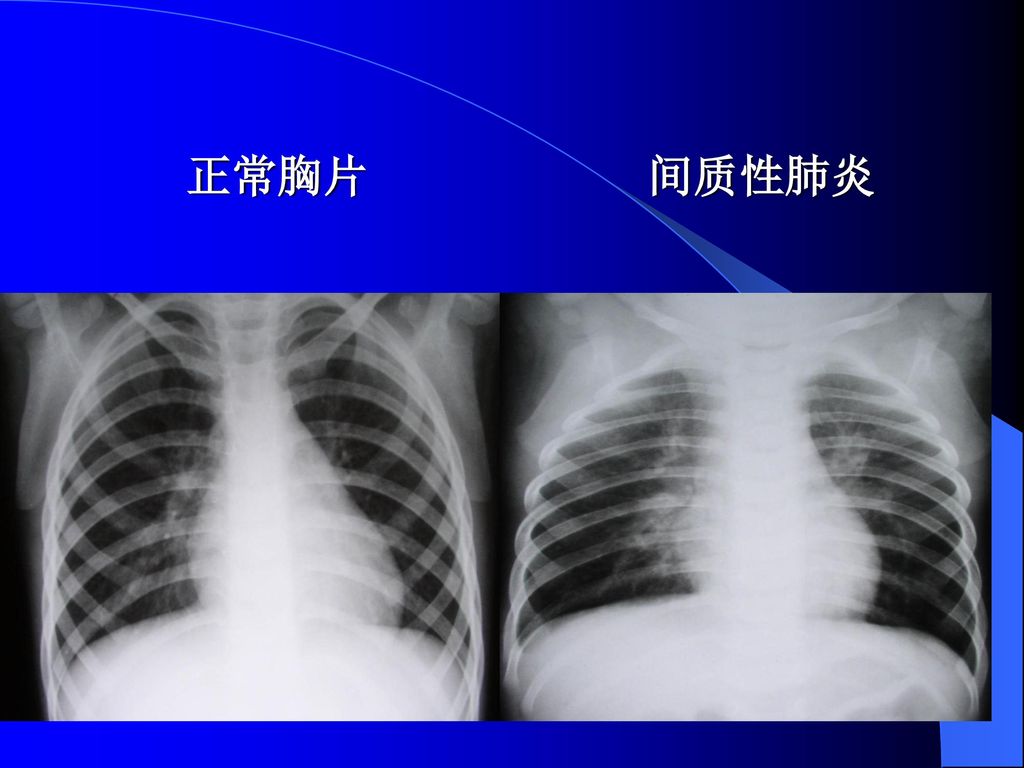 正常胸片支气管肺炎 正常胸片大叶性肺炎 正常胸片间质性肺炎 正常
