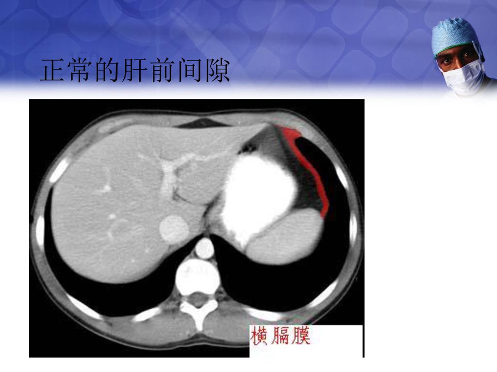 正常影像 双膈下游离气体 正常的肝前间隙 右侧肝前间隙游离气体