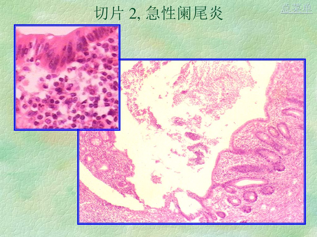 切片 2, 急性阑尾炎总菜单 切片 3,  肾脓肿总菜单 切片 4, 慢性胆囊