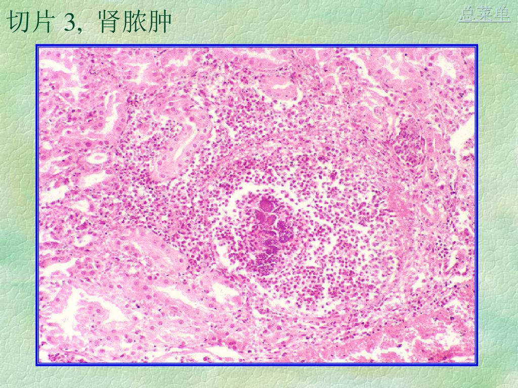 切片 2, 急性阑尾炎总菜单 切片 3,  肾脓肿总菜单 切片 4, 慢性胆囊