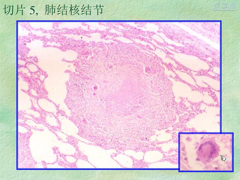 1, 纤维素性心包炎总菜单 切片 2, 急性阑尾炎总菜单 切片 3,  肾脓肿