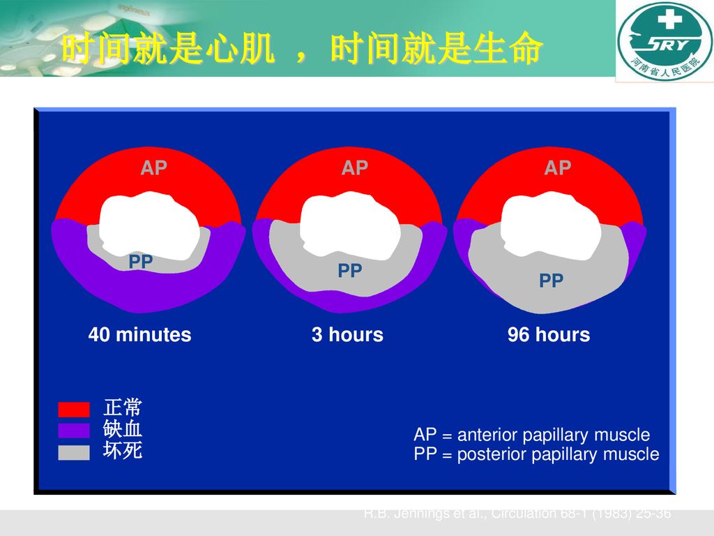 时间就是心肌 ，时间就是生命 AP AP AP 40 minutes 3 hours 96 hours 正常 缺血 坏死 PP PP PP