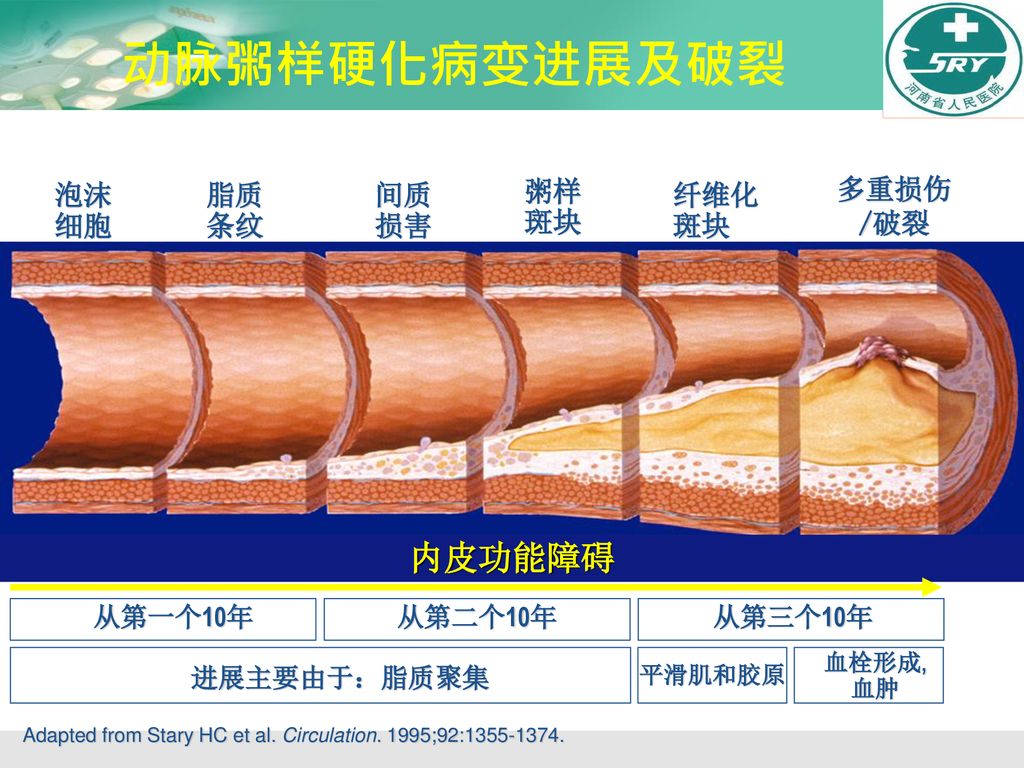 动脉粥样硬化病变进展及破裂 内皮功能障碍 多重损伤 /破裂 泡沫 细胞 脂质 条纹 间质 损害 粥样 斑块 纤维化 斑块 从第一个10年