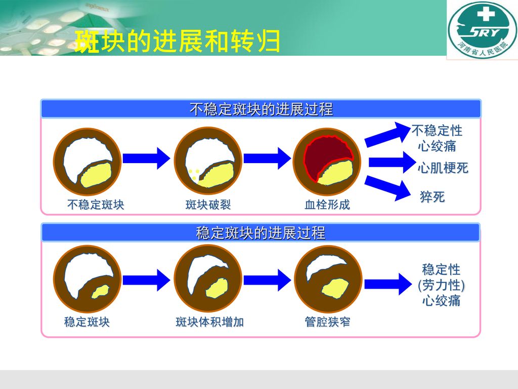 斑块的进展和转归 不稳定斑块的进展过程 稳定斑块的进展过程 不稳定性 心绞痛 心肌梗死 猝死 稳定性 (劳力性) 心绞痛 不稳定斑块