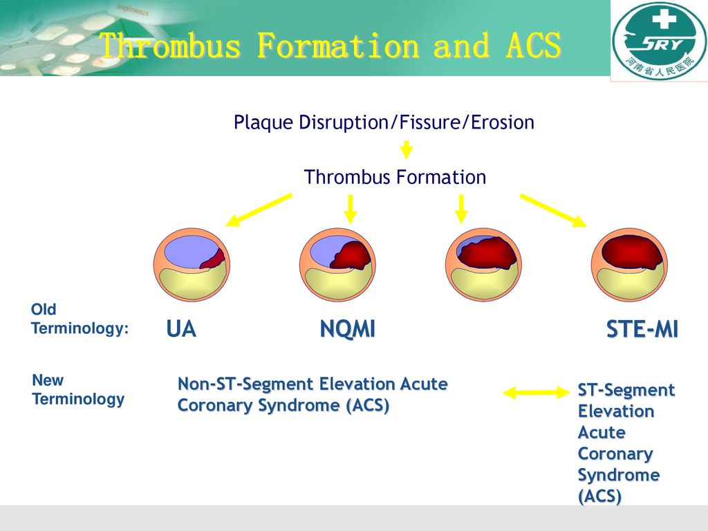 Thrombus Formation and ACS