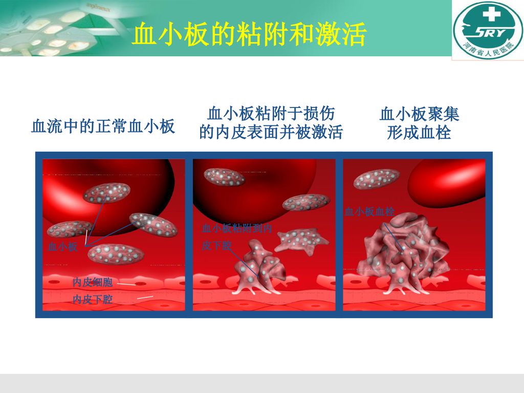 血小板的粘附和激活 血小板粘附于损伤 血小板聚集 的内皮表面并被激活 形成血栓 血流中的正常血小板 血小板血栓 血小板粘附到内 皮下腔