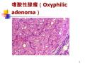 1 嗜酸性腺瘤（ Oxyphilic adenoma ）. 2 基底细胞腺瘤（ basal cell adenoma ） 多见于男性老年人，主要发生在腮腺.