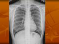 肺栓塞与肺梗死 2012 级 何莺 肺栓塞概况 肺栓塞（ PE ）是内 源性 / 外源性栓子堵塞 肺动脉而引起的肺循 环障碍所致的临床和 病理生理综合征。 肺栓塞（ pulmonary embolism, PE ）是内 源性 / 外源性栓子堵塞 肺动脉而引起的肺循 环障碍所致的临床和 病理生理综合征。