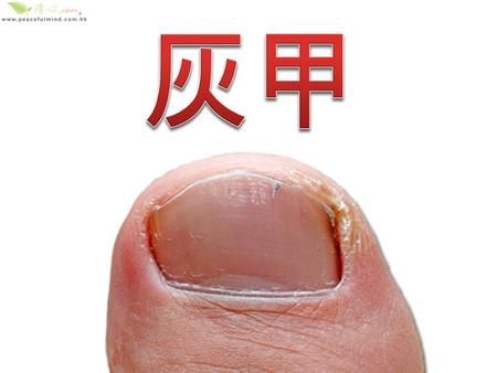 醫學上，「灰甲」稱為指趾甲真菌症，即是真菌入 侵甲床，並以角質為養分而滋生和繁衍。致病真菌 有許多不同的種類，一般可分為以下三大類：皮癬 菌 ( 最常見 ) 、酵母菌和黴菌。它們通過侵入身體角 質化組織而感染皮膚癬、甲癬等。