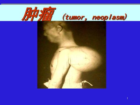 肿瘤 (tumor，neoplasm).