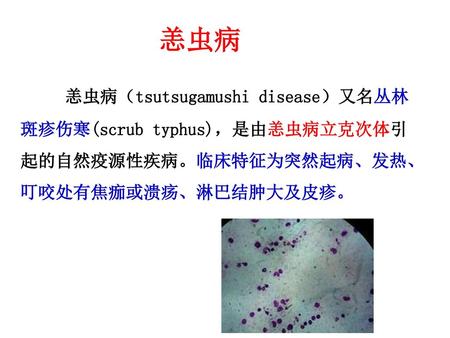 恙虫病 恙虫病（tsutsugamushi disease）又名丛林斑疹伤寒(scrub typhus)，是由恙虫病立克次体引起的自然疫源性疾病。临床特征为突然起病、发热、叮咬处有焦痂或溃疡、淋巴结肿大及皮疹。