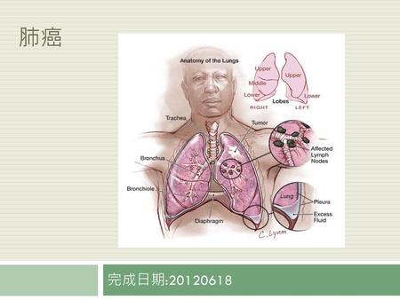 肺癌 完成日期:20120618.