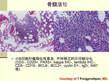 骨髓活检 小B细胞肿瘤局灶性累及，不伴明显的浆细胞分化 (CD3-, CD20+, PAX5+, kappa IHC-, lambda IHC-, CD5-, CD10-, BCL6-, BCL2+, cyclin D1-, IgD-, Ki67 低) Courtesy of T Pongpruttipan,
