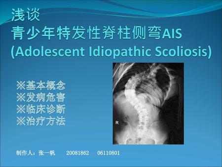 浅谈 青少年特发性脊柱侧弯AIS (Adolescent Idiopathic Scoliosis)