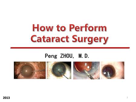 How to Perform Cataract Surgery
