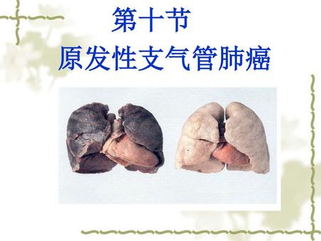 第十节 原发性支气管肺癌.