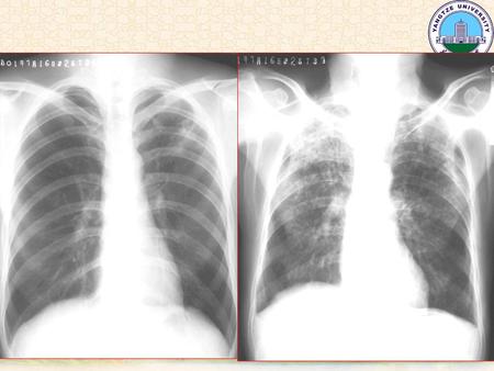 肺肿瘤 Pulmonary neoplasms