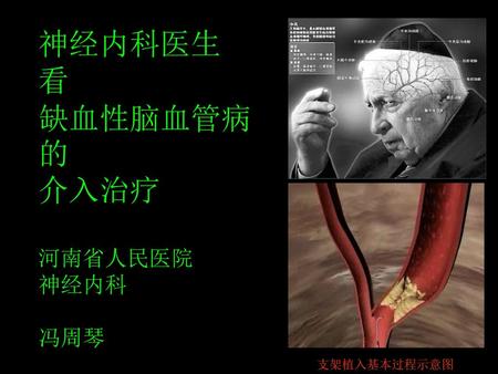 神经内科医生 看 缺血性脑血管病的 介入治疗 河南省人民医院 神经内科 冯周琴 支架植入基本过程示意图.